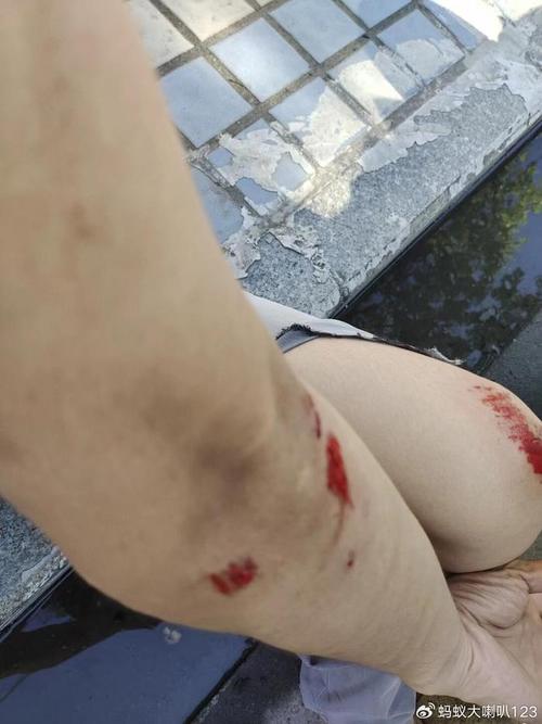 同一位置受伤，不同公司责任如何划分？-图1